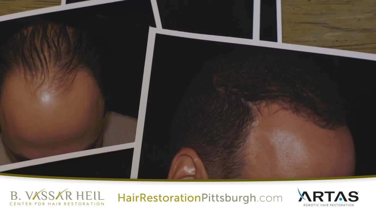 ARTAS Hair Transplant in Pittsburgh, PA