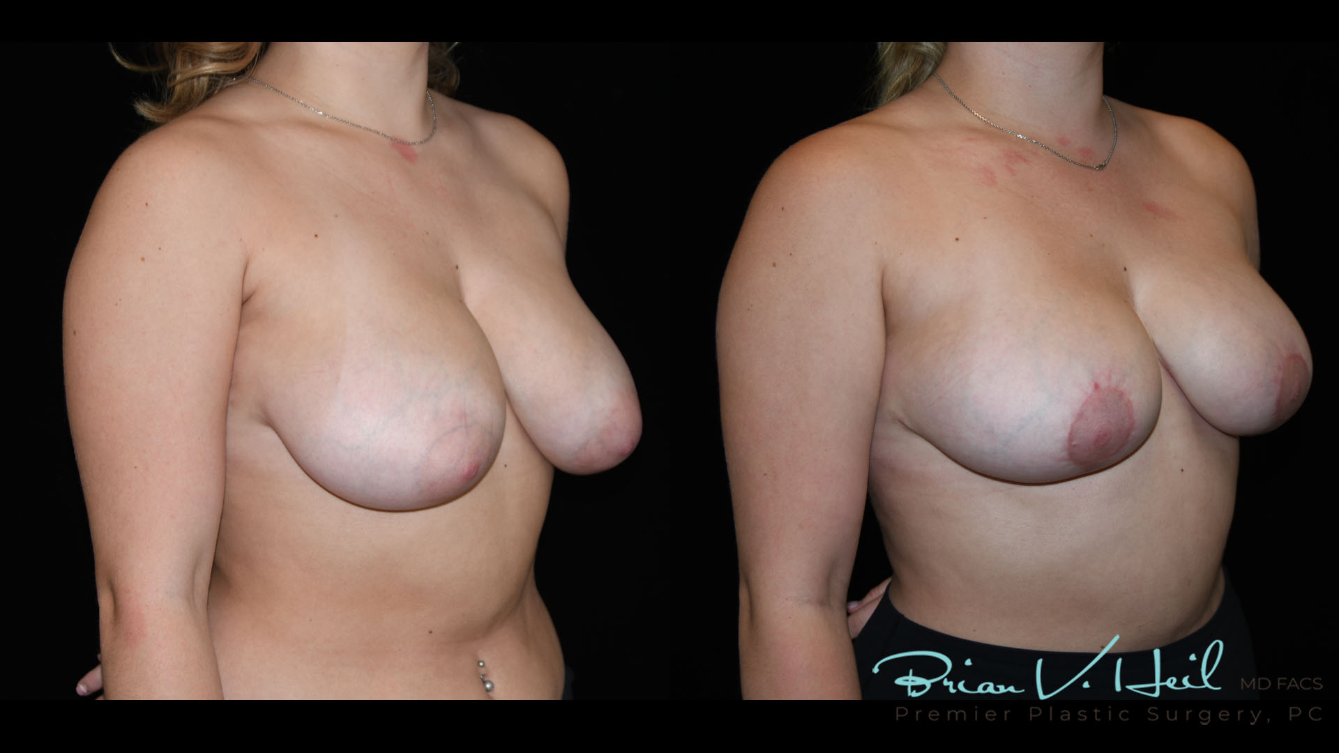 Breast Lift Surgery in Pittsburgh, PA