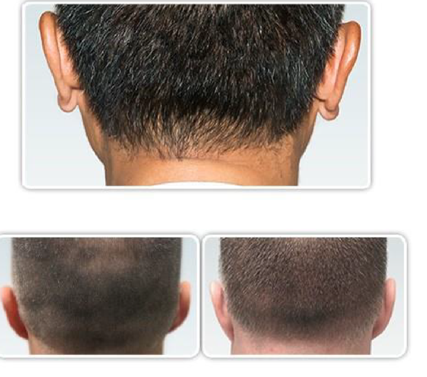 Hair Transplant Before and After 02  Sistine Facial Plastic Surgery