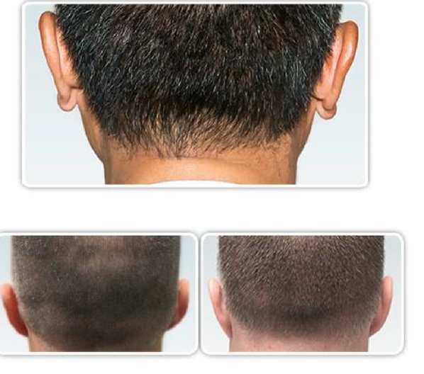 ARTAS Hair Transplant in Pittsburgh, PA