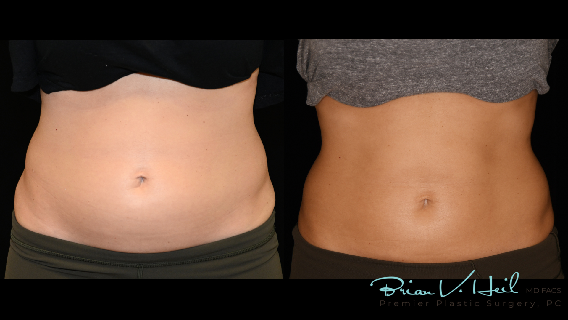 EMSculpt Neo Edge - What Body Problems Can It Fix? OR How EMSculpt