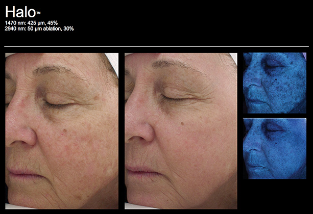 Laser Skin Resurfacing Pittsburgh