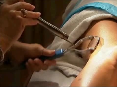 Laser Vein Therapy Pittsburgh