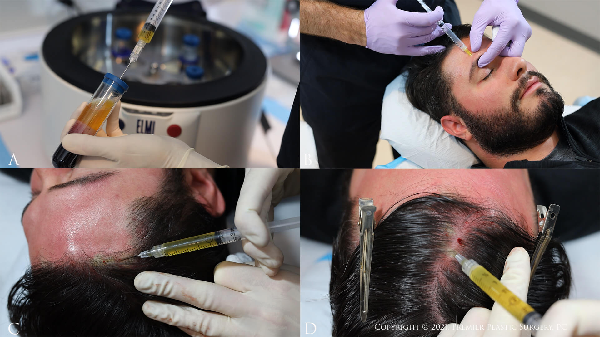 Other Hair Restoration Technology