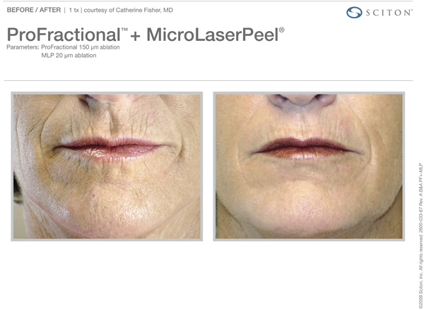 Microlaser Peels Pittsburgh, PA