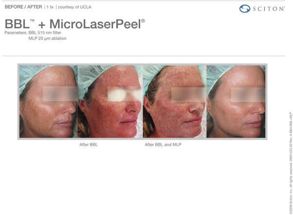 Microlaser Peels Pittsburgh, PA