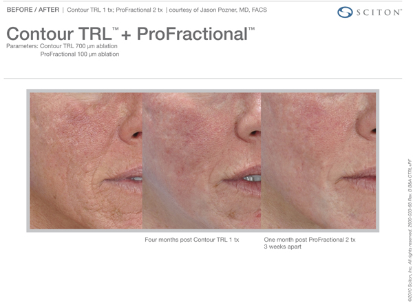 Profractional Laser Pittsburgh