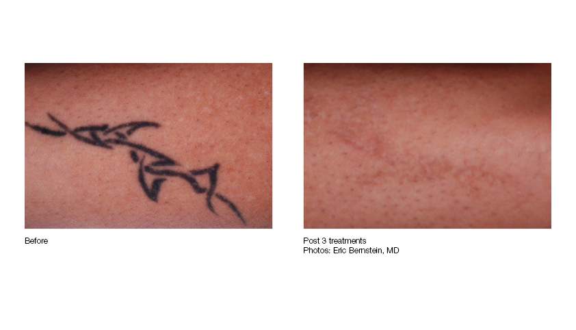 Tattoo Removal in OKC 20 OFF  Less Pain Less Downtime