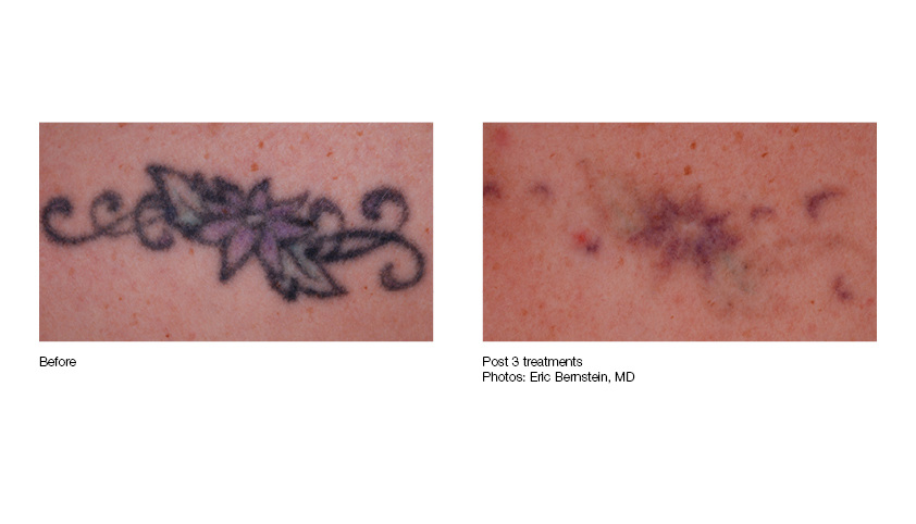 Laser Tattoo Removal in Pittsburgh, PA