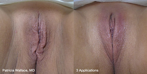 Vaginal Rejuvenation Pittsburgh