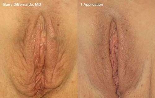 Vaginal Rejuvenation Pittsburgh