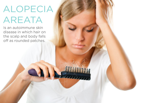 alopecia-areata