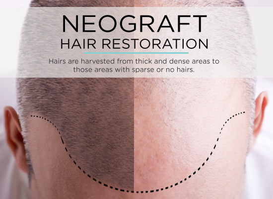 neograft