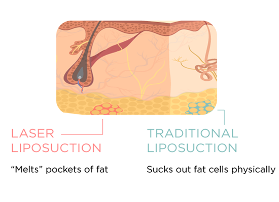 traditional-verses-laser-liposuction