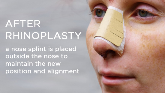 after-rhinoplasty