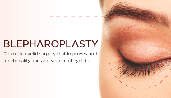 blepharoplasty