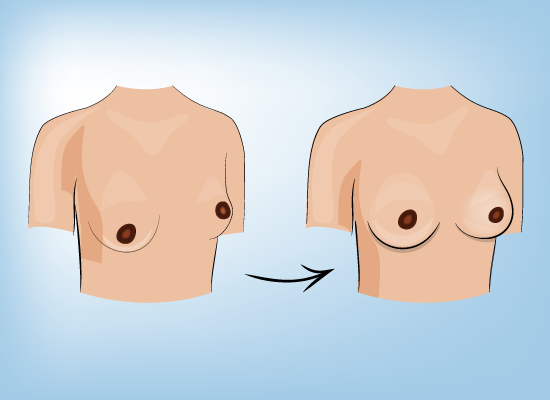 Best Procedures For 40's: Breast Augmentation Combined With Breast Lift -  Premier Plastic Surgery