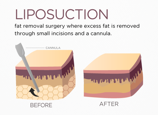 liposuction