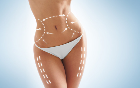 Liposuction