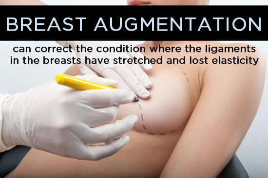 breast augmentation