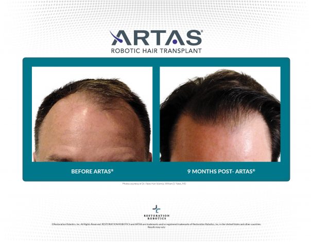 The Ultimate Guide to ARTAS™ Robotic Hair Restoration - Premier Plastic  Surgery