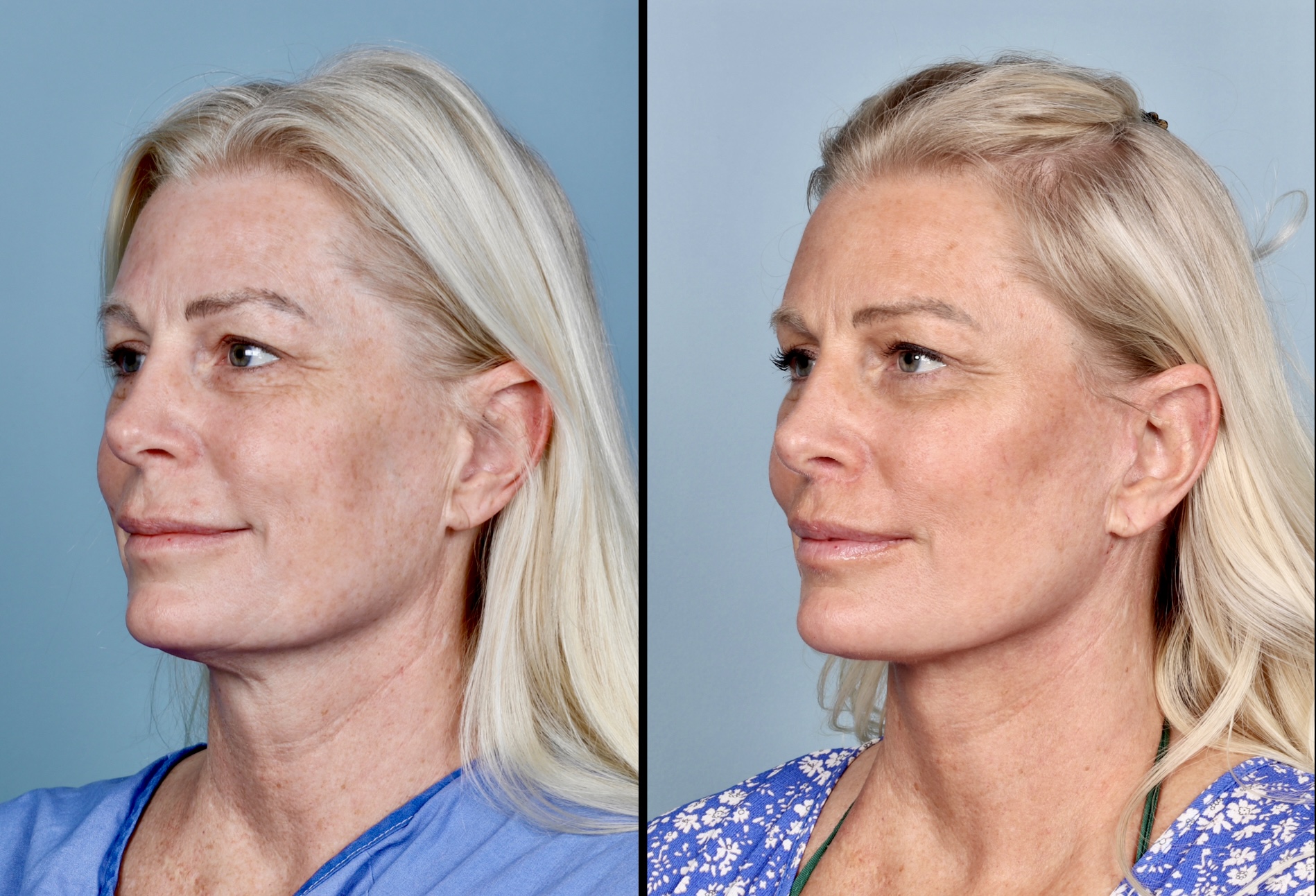 Deep Plane Facelift