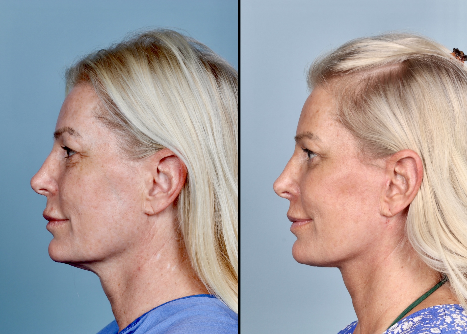 Deep Plane Facelift