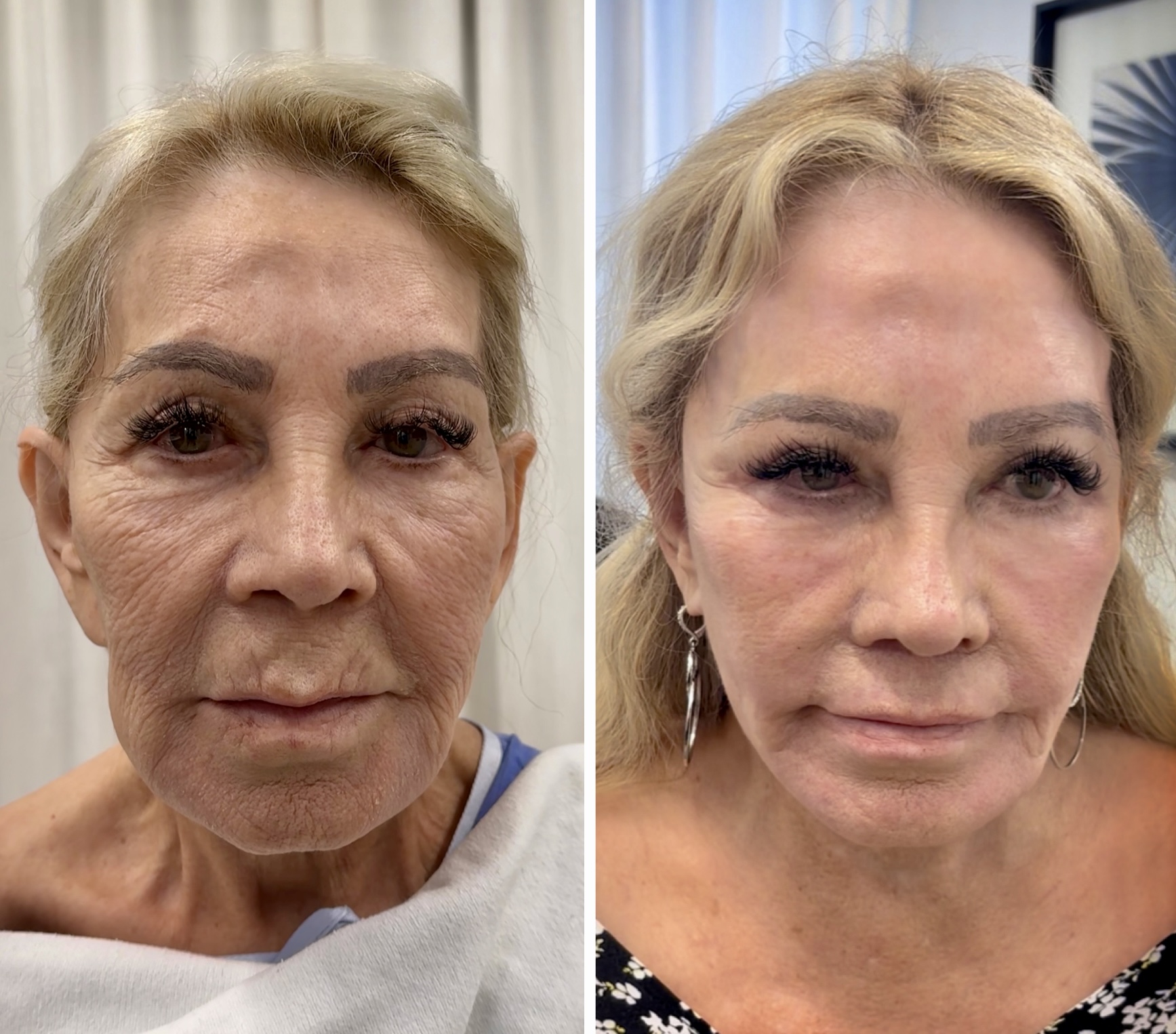 Deep Plane Facelift
