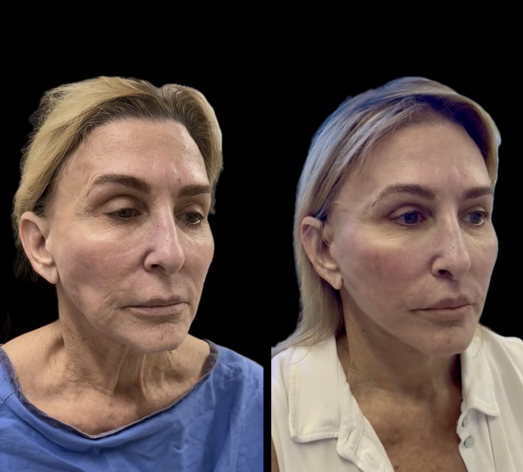 Deep Plane Facelift