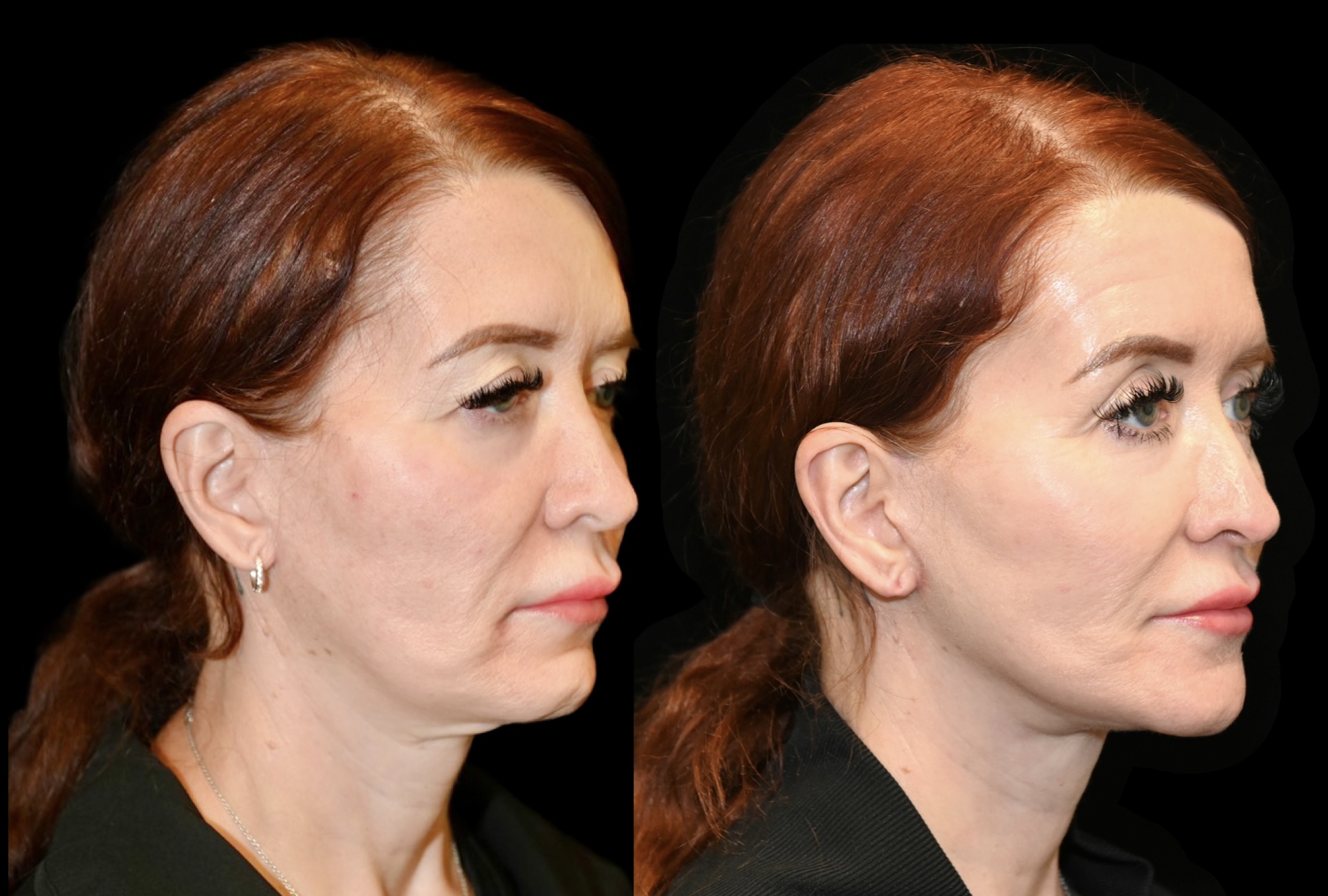 Deep Plane Facelift