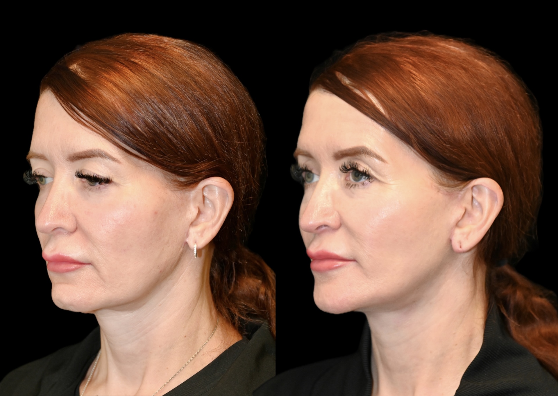 Deep Plane Facelift