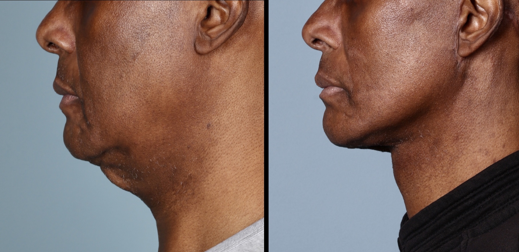 Deep Plane Facelift