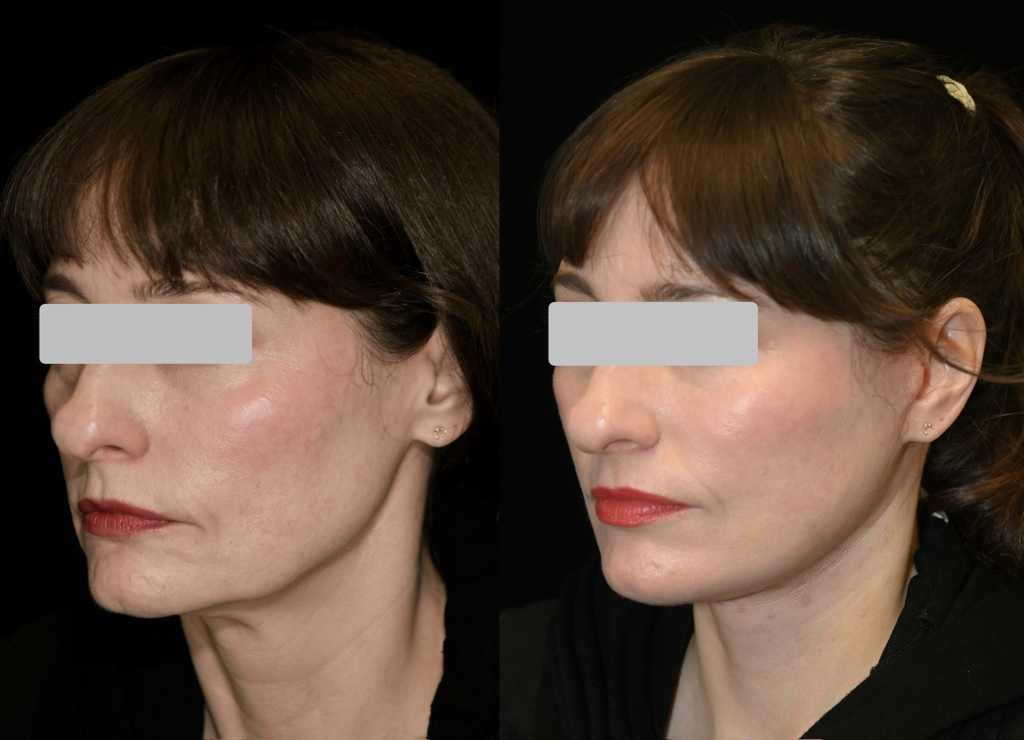 Deep Plane Facelift