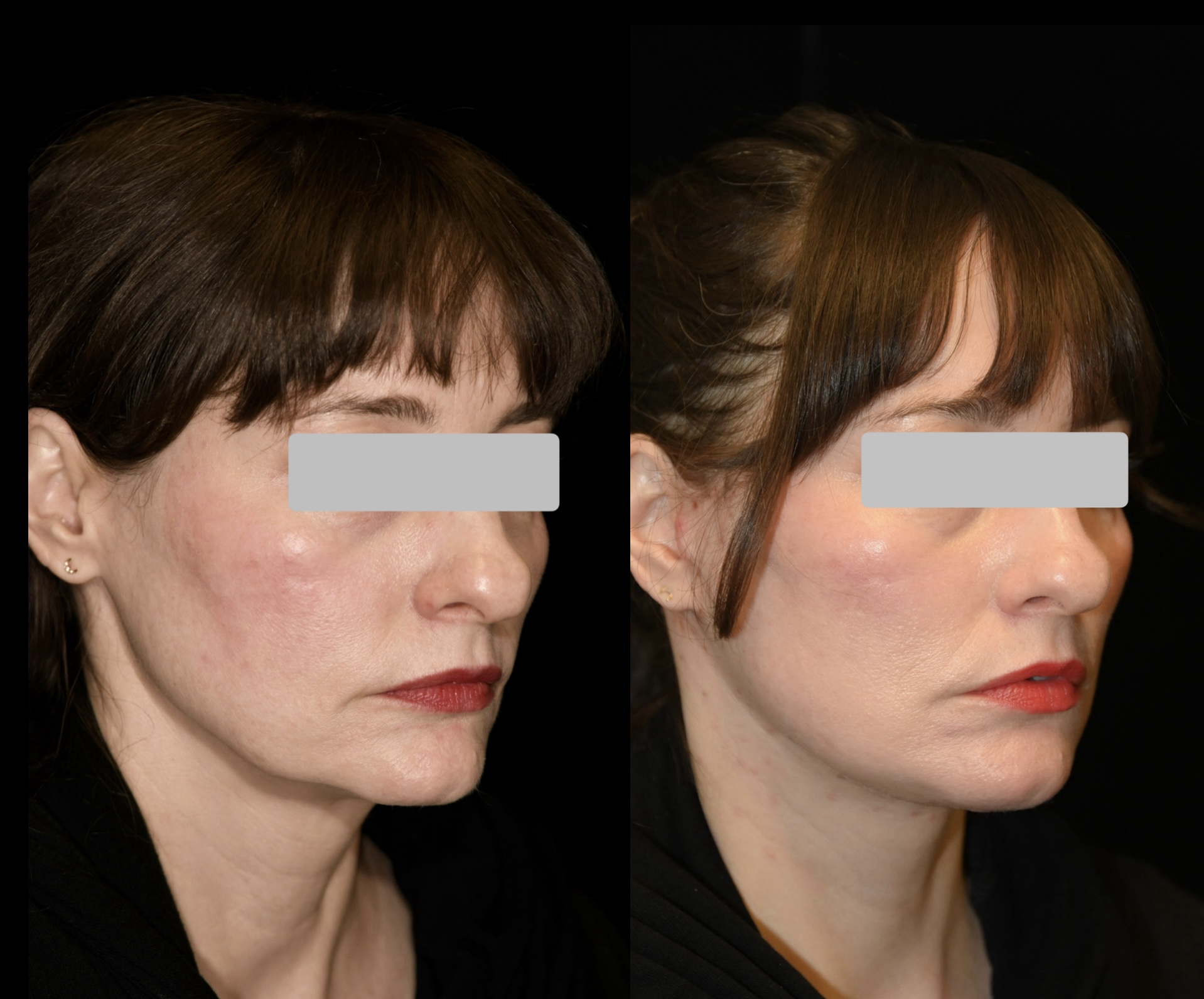 Deep Plane Facelift