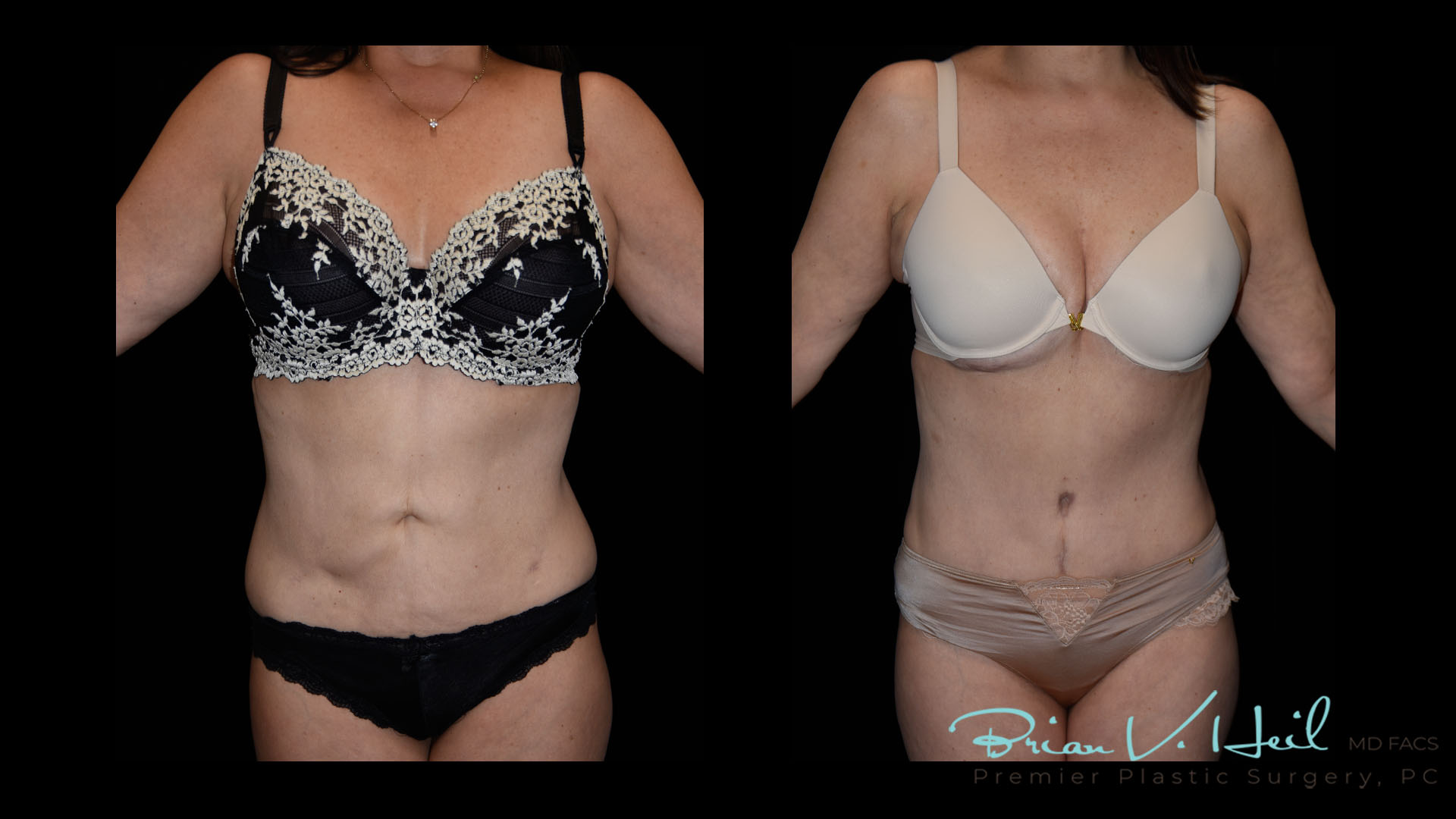 Tummy Tuck Morgantown