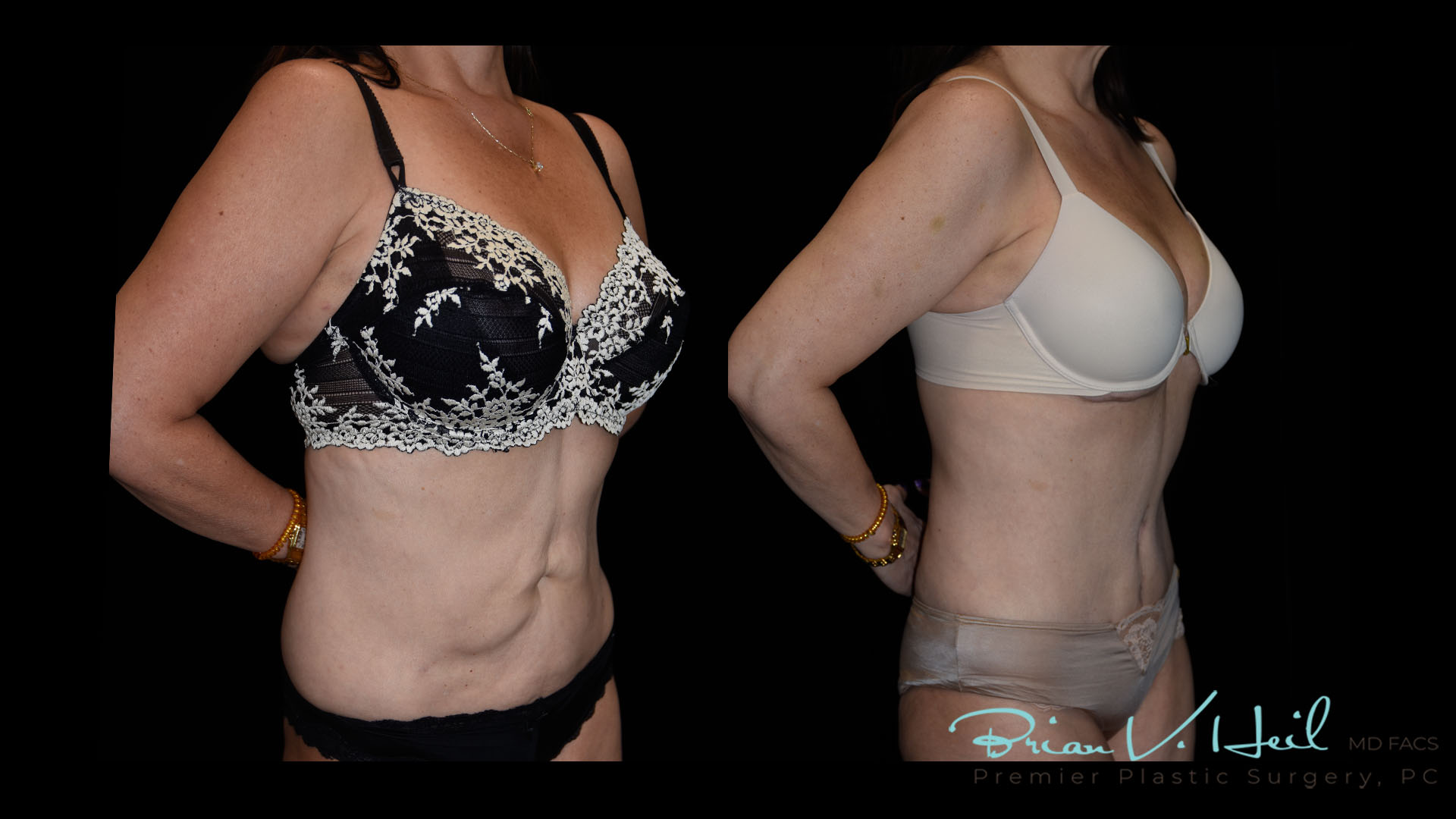 Tummy Tuck Morgantown