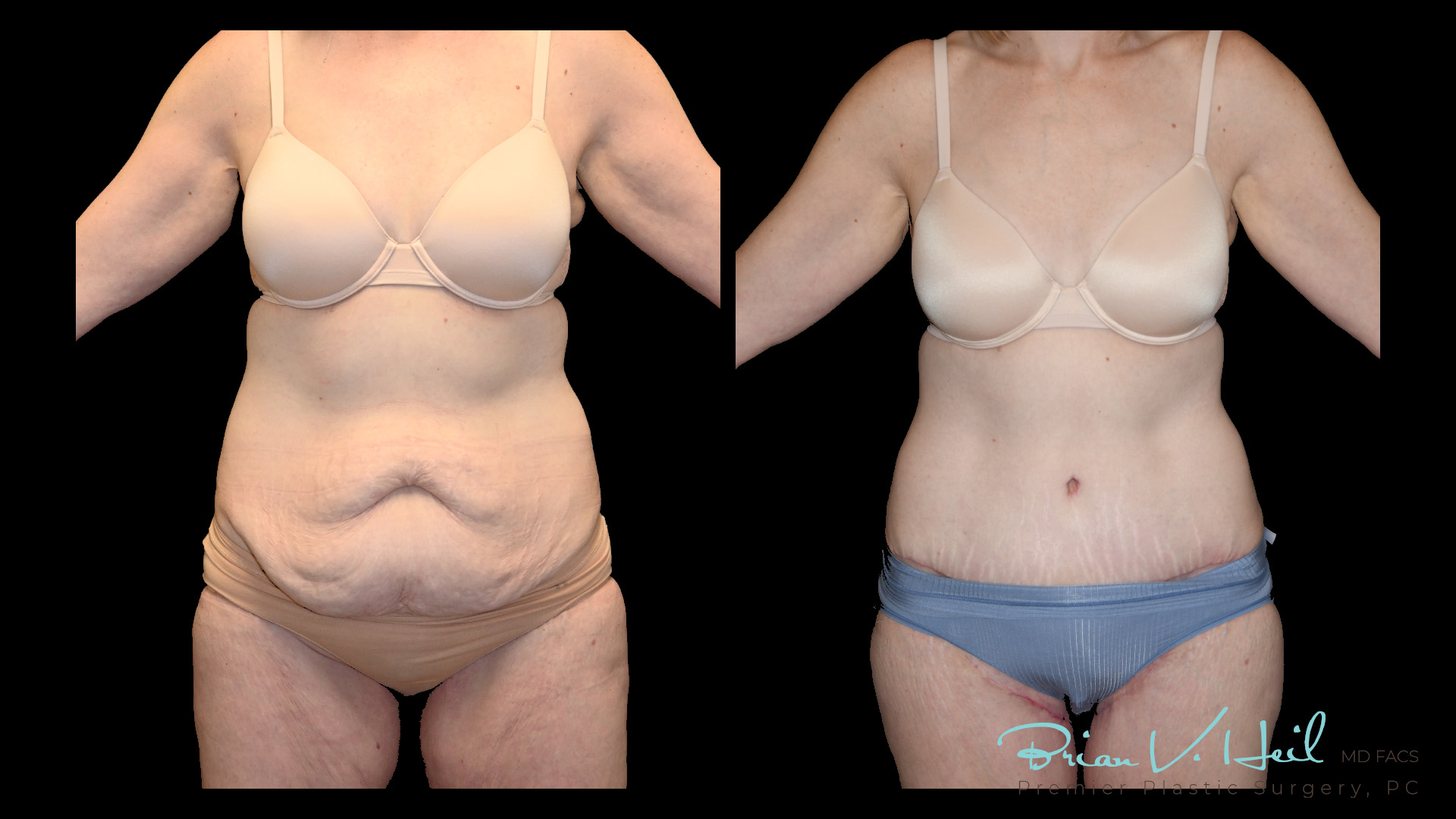 Tummy Tuck Morgantown