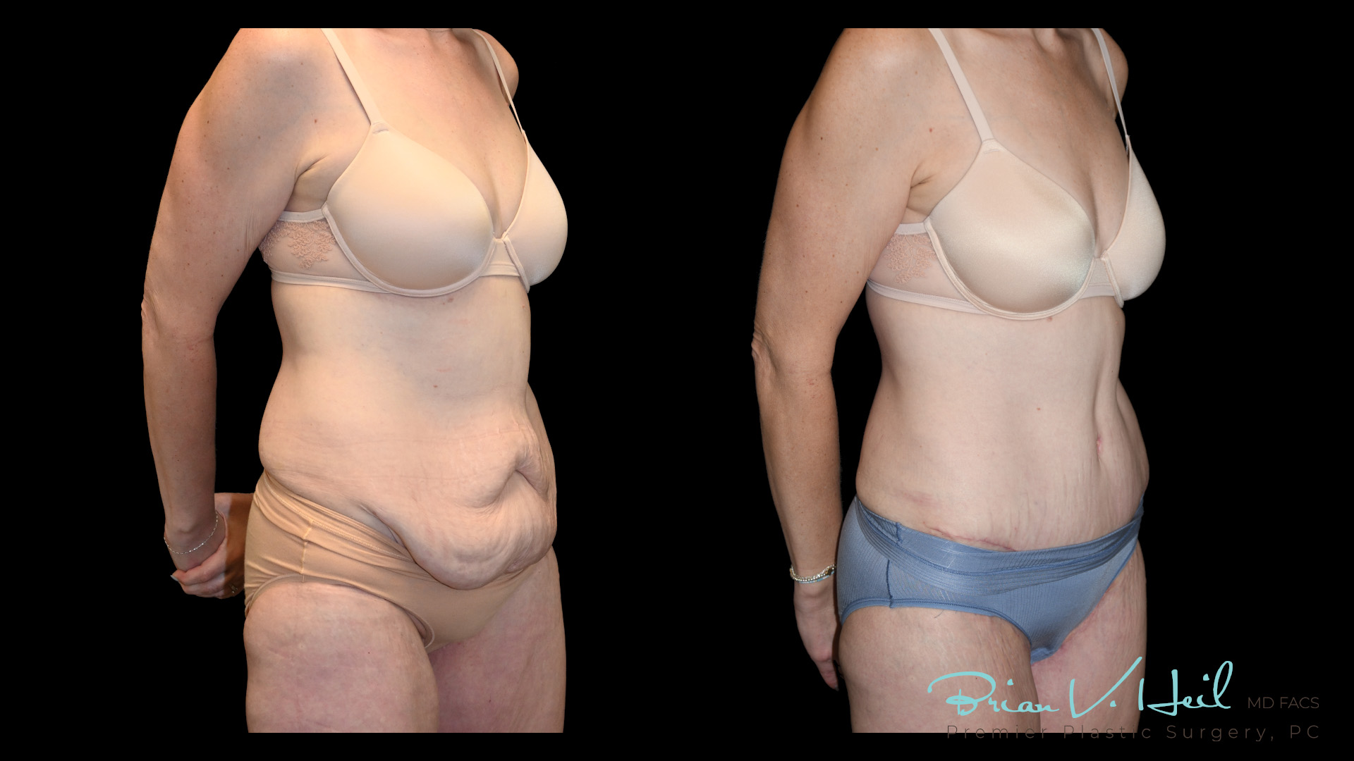 Tummy Tuck Pittsburgh