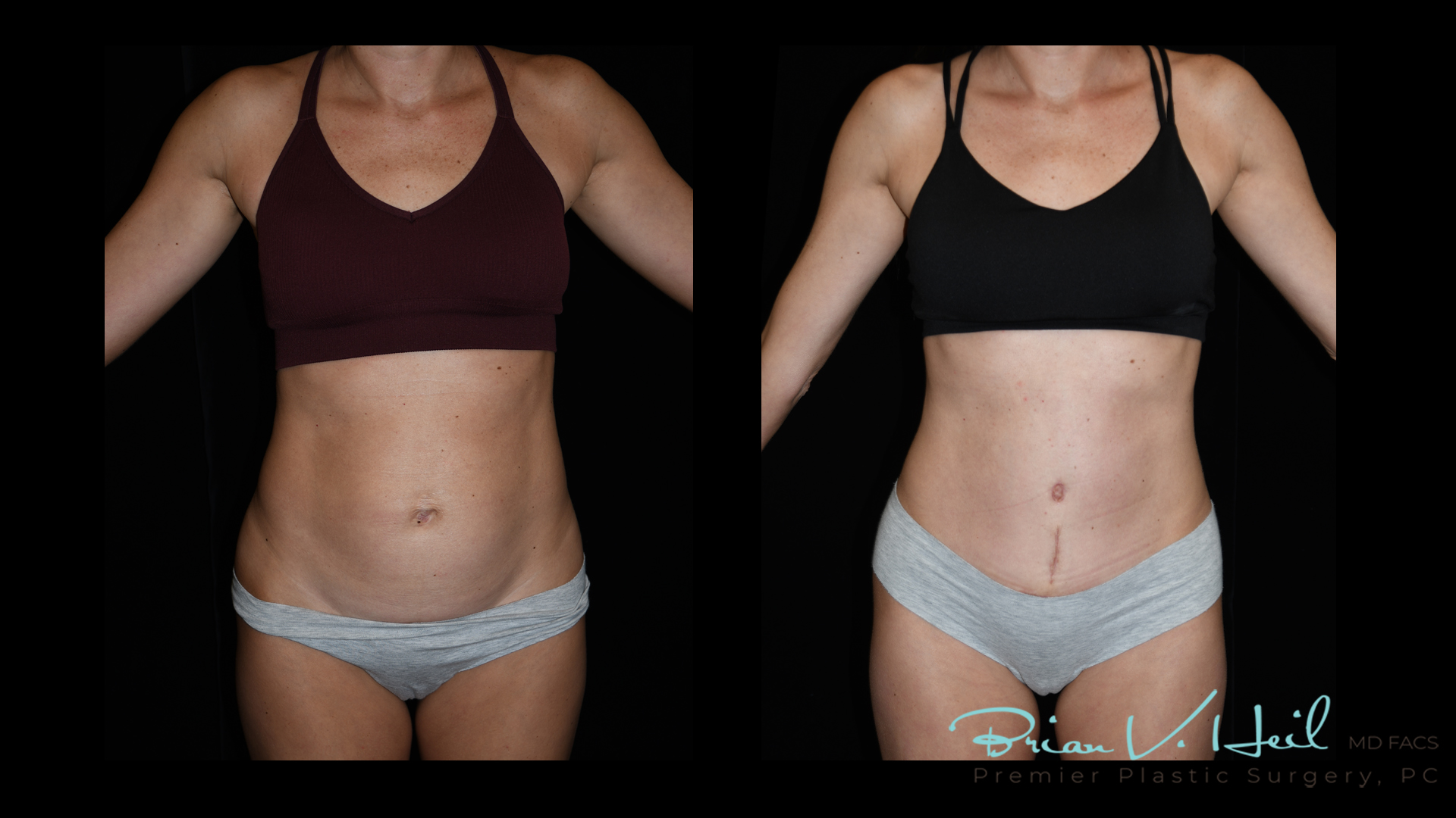 Abdominoplasty Before and After | Premier Plastic Surgery