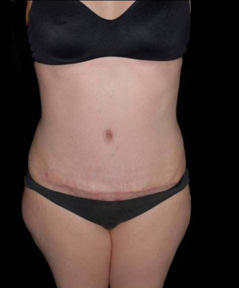 Abdominoplasty Before and After | Premier Plastic Surgery