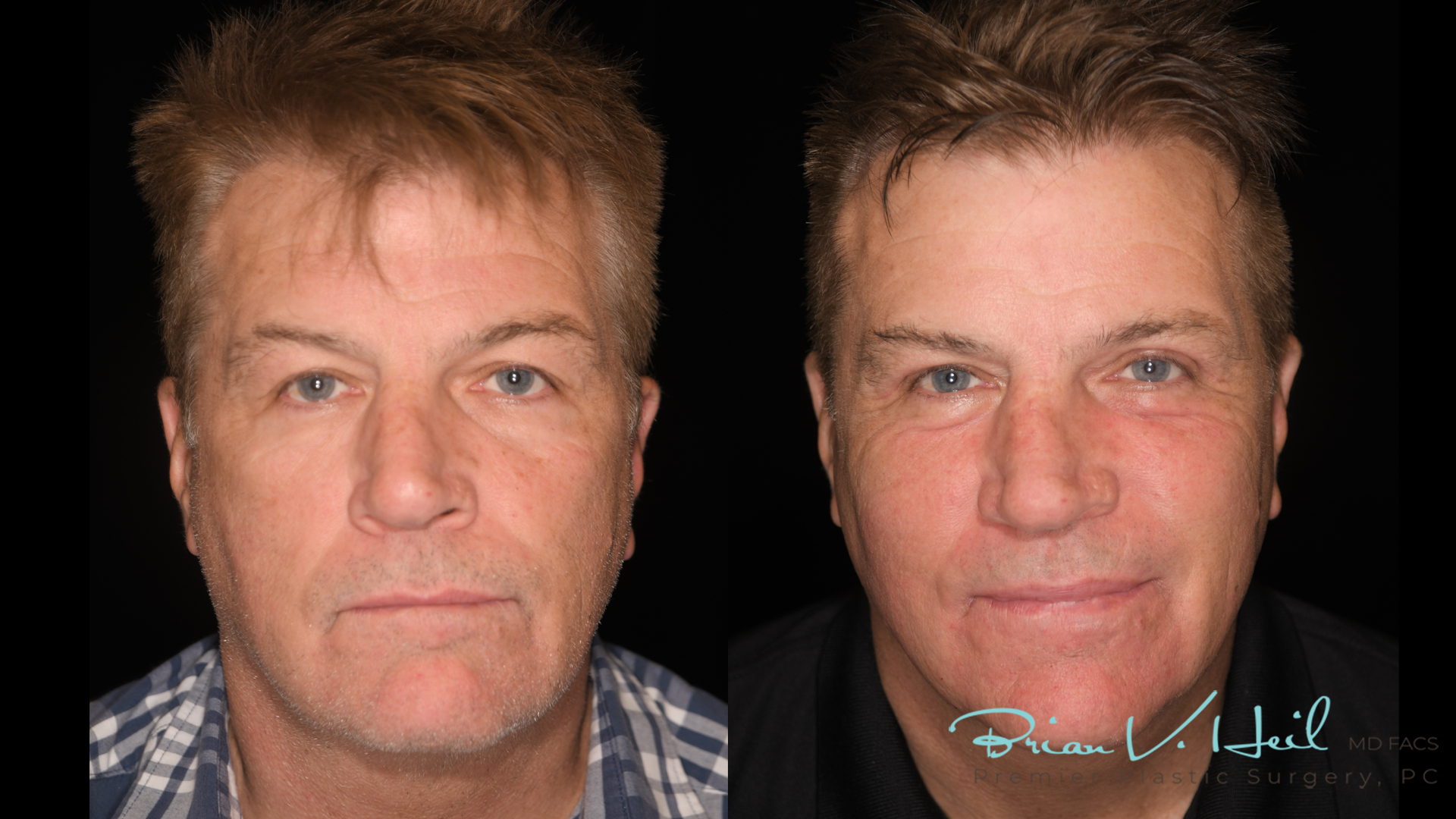 Blepharoplasty in Pittsburgh, PA