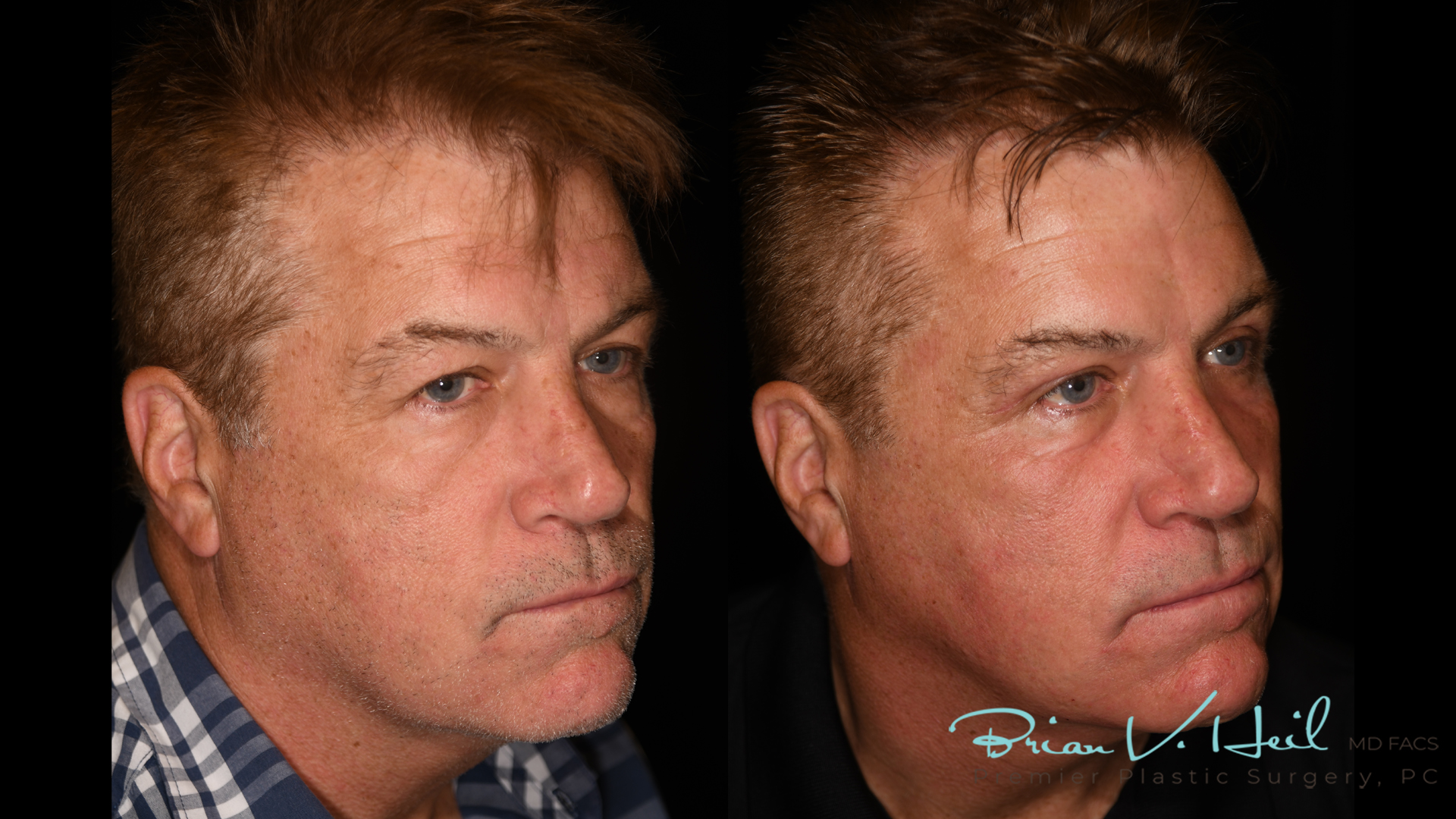 Blepharoplasty in Pittsburgh, PA