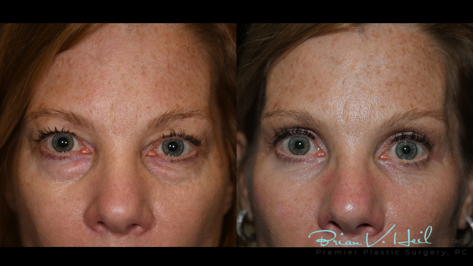 Blepharoplasty in Pittsburgh, PA