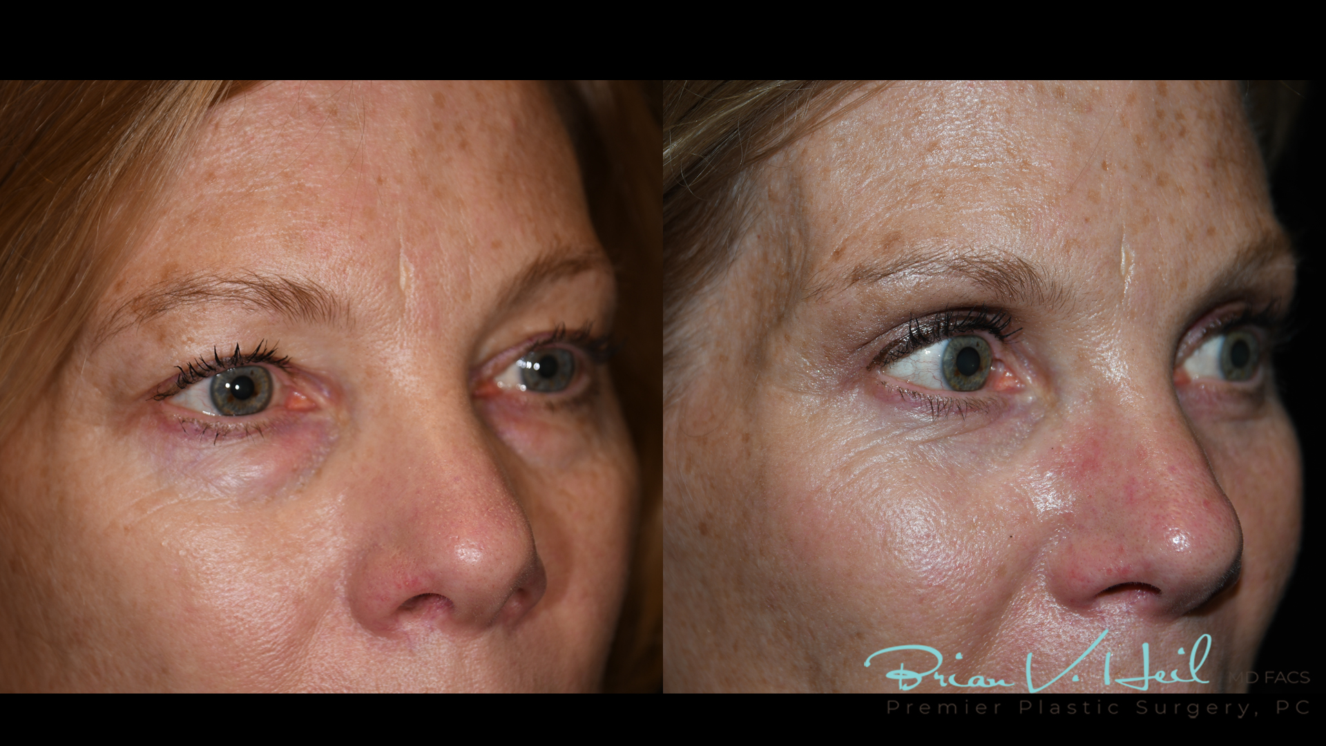 Blepharoplasty in Pittsburgh, PA