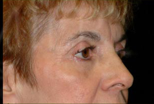 Blepharoplasty Before and After | Premier Plastic Surgery