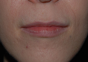 BOTOX in Pittsburgh