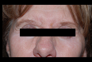 BOTOX in Pittsburgh
