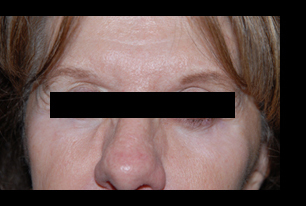 BOTOX in Pittsburgh