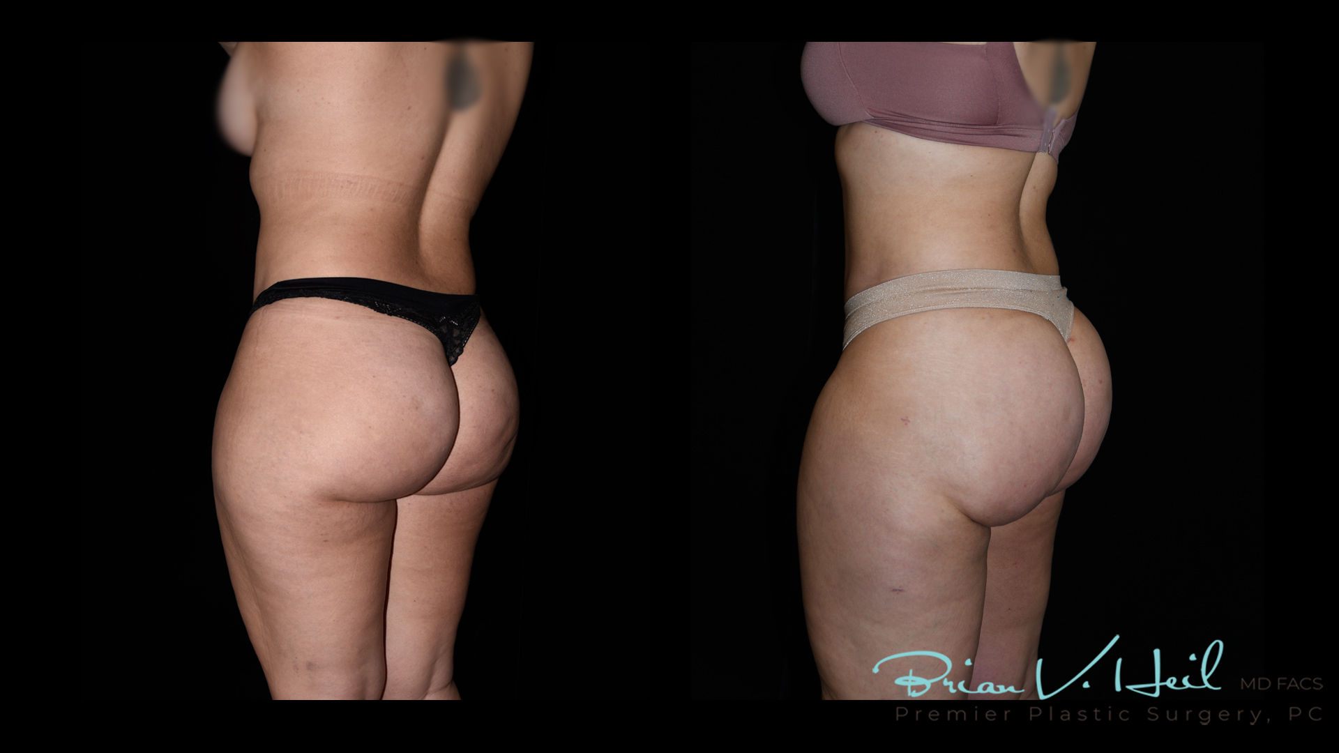 Brazilian Butt Lift Before and After | Premier Plastic Surgery