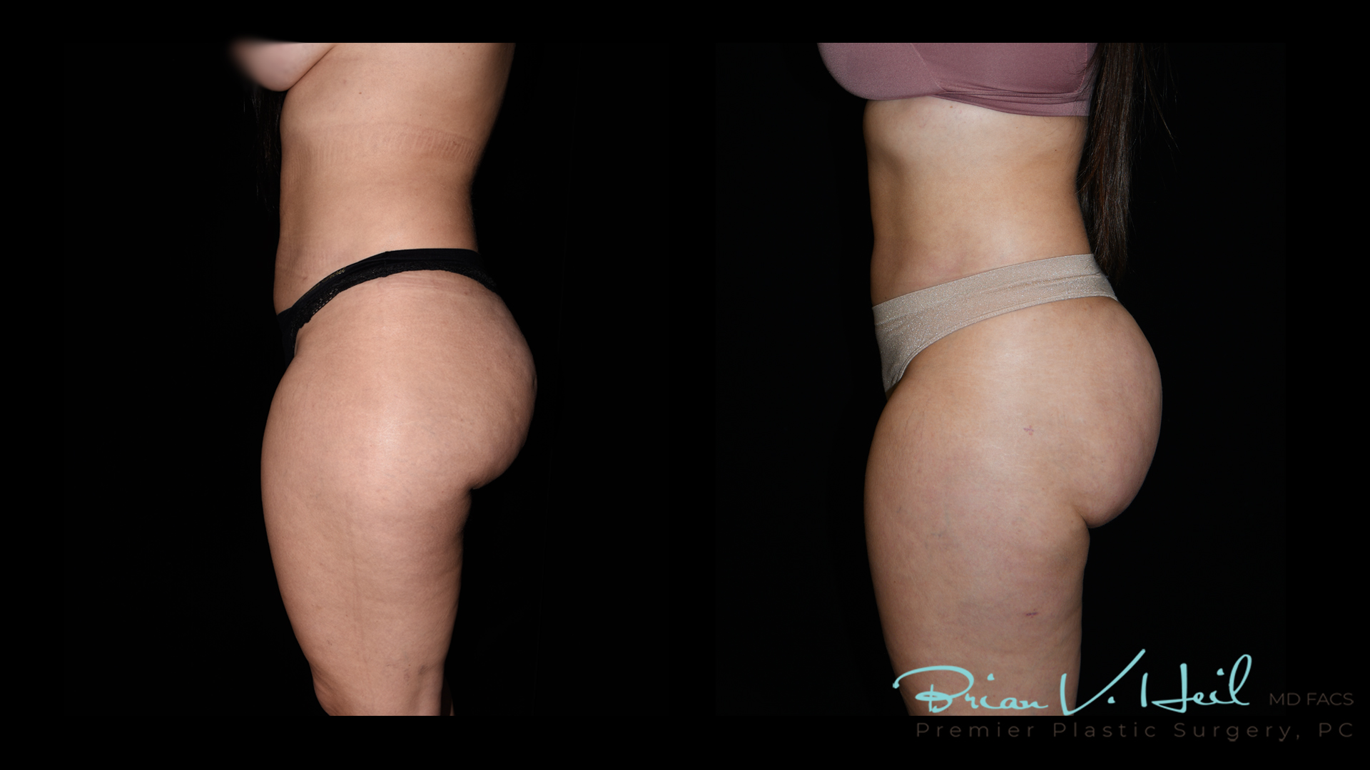 Brazilian Butt Lift Before and After | Premier Plastic Surgery